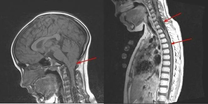 Аномалия арнольда киари что это простыми. Аномалия Арнольда-Киари 1. Мальформация Киари 1 типа. Мальформация Арнольда-Киари 1. Аномалия Киари 1 типа на мрт.