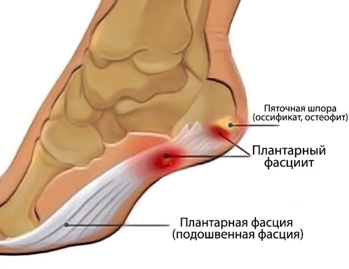 Пяточный фасцит