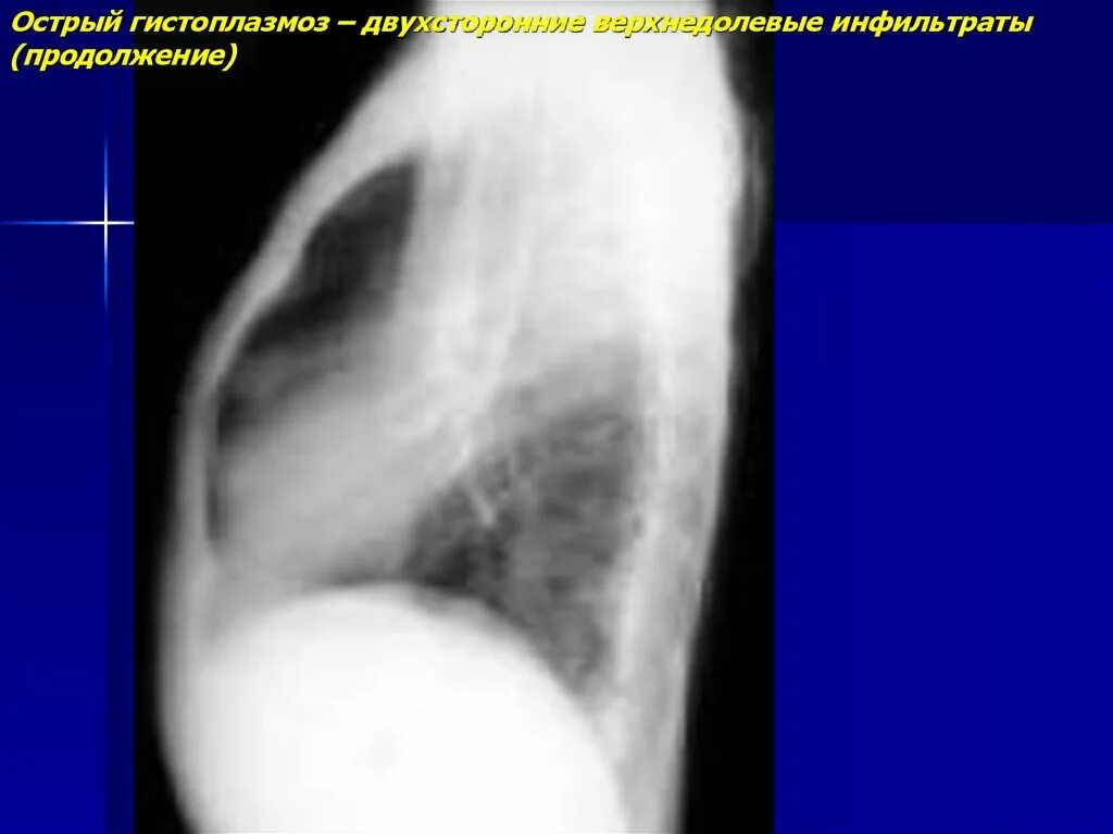 Легочная язва. Острый легочный гистоплазмоз. Гистоплазмоз - грибковая инфекция. Грибковые заболевания легких рентген.