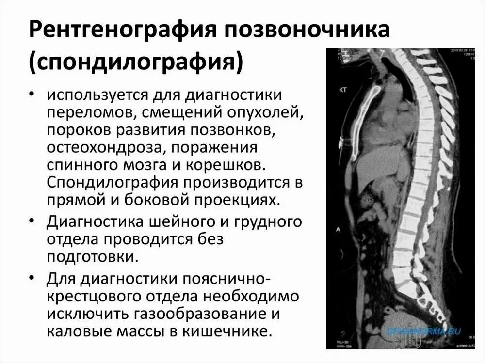 Остеохондроз th5-th8. Диагностика грудного отдела позвоночника. Методы исследования при остеохондрозе. Остеохондроз методы обследования. Обследование при остеохондрозе поясничного отдела.