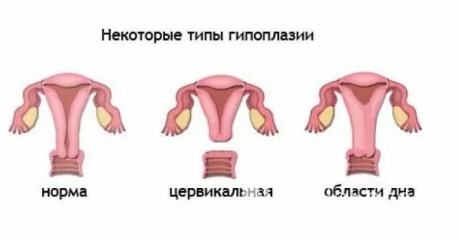 Гипоплазия матки классификация. Инфантильная матка размеры. Гипоплазия матки на узи. Инфантильная матка. Степени недоразвития матки.
