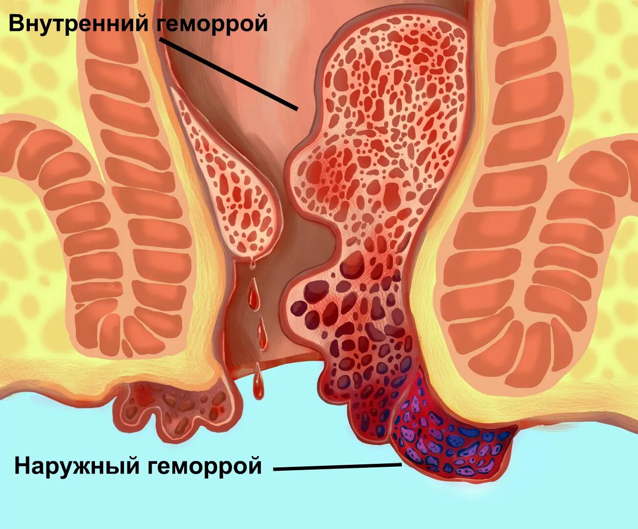 Боль в заднем проходе при беременности