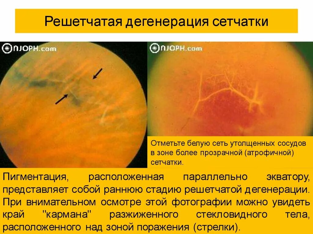 Пигментная дистрофия сетчатки глаза. Периферическая витреохориоретинальная дистрофия сетчатки. Дистрофия клетчатки. Инеевидная дегенерация сетчатки. Дегенерация центральной сетчатки глаза.