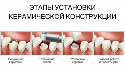 Можно ли ставить керамическую