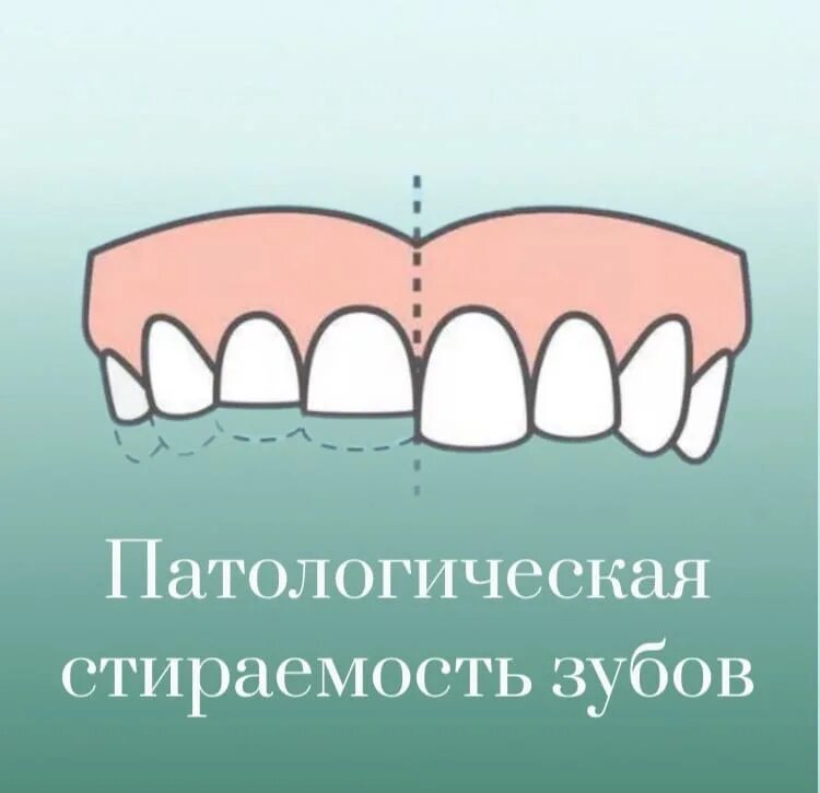 Как выглядит стираемость зубов Маргарита стоматология в Благовещенске. Лечение, протезирование, отбеливание,