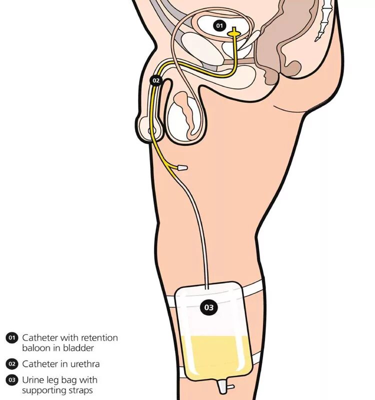 Катетер простату. Катетер при аденоме простаты. Цистостома мочевого пузыря катетер. Катетер в мочевом при аденоме простаты. Катетер Фолея схема.