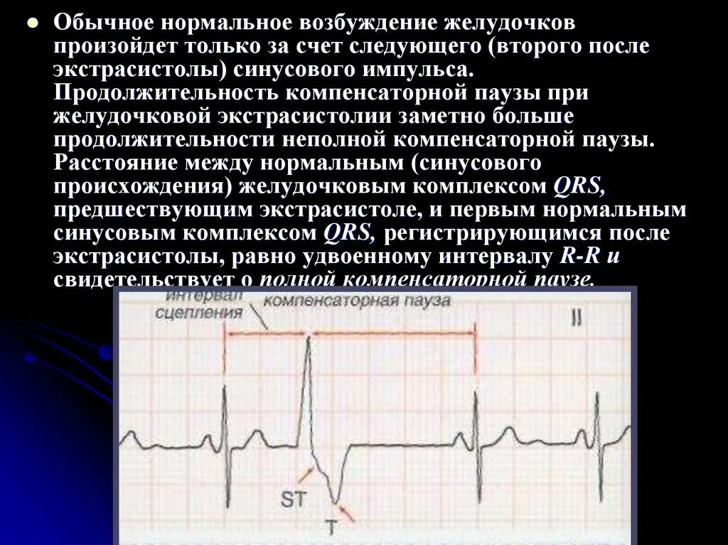 Наджелудочковая экстрасистолия неполная компенсаторная пауза. Экстрасистолия полная и неполная компенсаторная пауза. Экстрасистола предсердия компенсаторная пауза. Компенсаторная пауза на ЭКГ. Экстрасистолы много