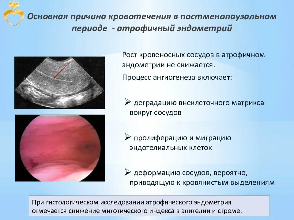 Причины сильного кровотечения. Кровотечения в постменопаузальном периоде. Причины кровотечений в постменопаузе. Основные причины кровотечения. Аномальные маточные кровотечения в постменопаузе причины.