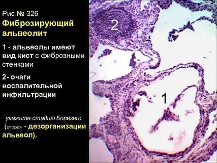 Фиброзирующий альвеолит