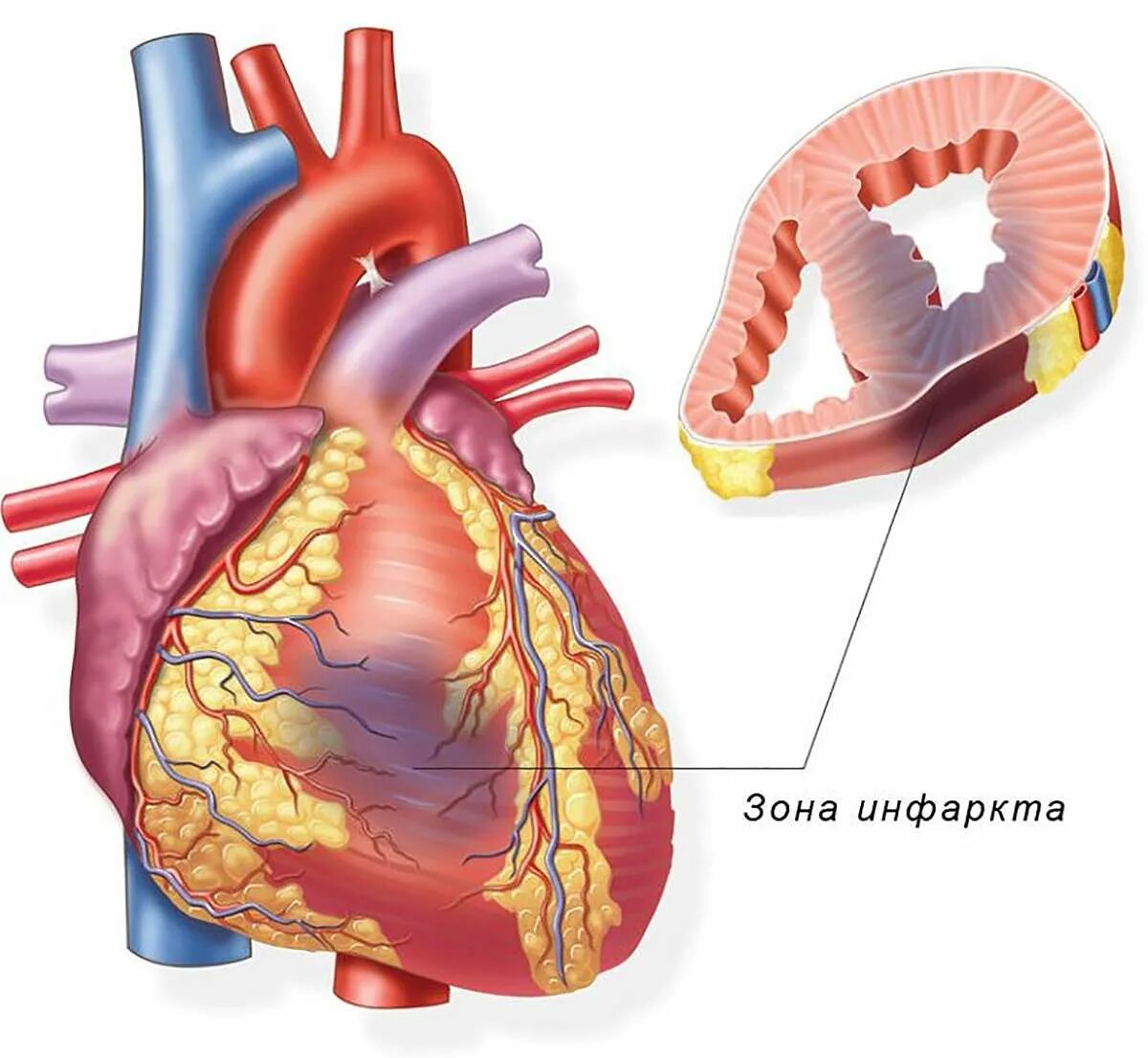 Инфаркт миокарда сердце. Форма очага некроза при остром инфаркте миокарда. Патологии сердца инфаркт миокарда. Инфаркт миокарда поражение. Зона ишемии
