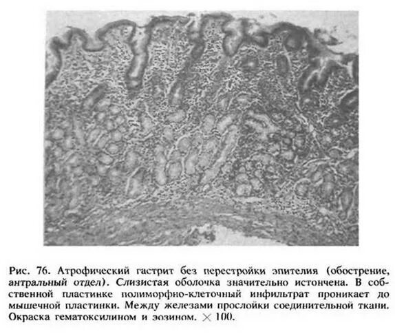 Атрофический гастрит патанатомия. Метаплазия желудка микропрепарат. Атрофический гастрит гистология. Атрофия слизистой оболочки желудка окраска гематоксилином. Признаки атрофией слизистой оболочки