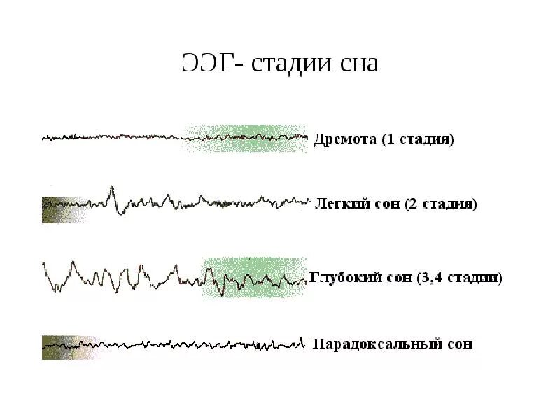 Ээг бодрствования. Фазы сна показатели ЭЭГ. Фазы медленного сна ЭЭГ. ЭЭГ В разные фазы сна. Показатели ЭЭГ медленного сна.