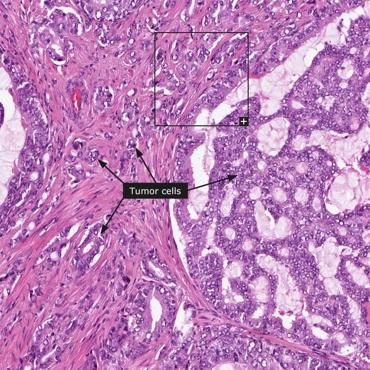 Ткани простаты. Карцинома предстательной железы гистология. Ацинарная аденокарцинома гистология. Ацинарная аденокарцинома предстательной железы гистология. Аденокарцинома железы гистология.