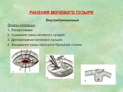 Удаление мочевого пузыря сколько длится операция