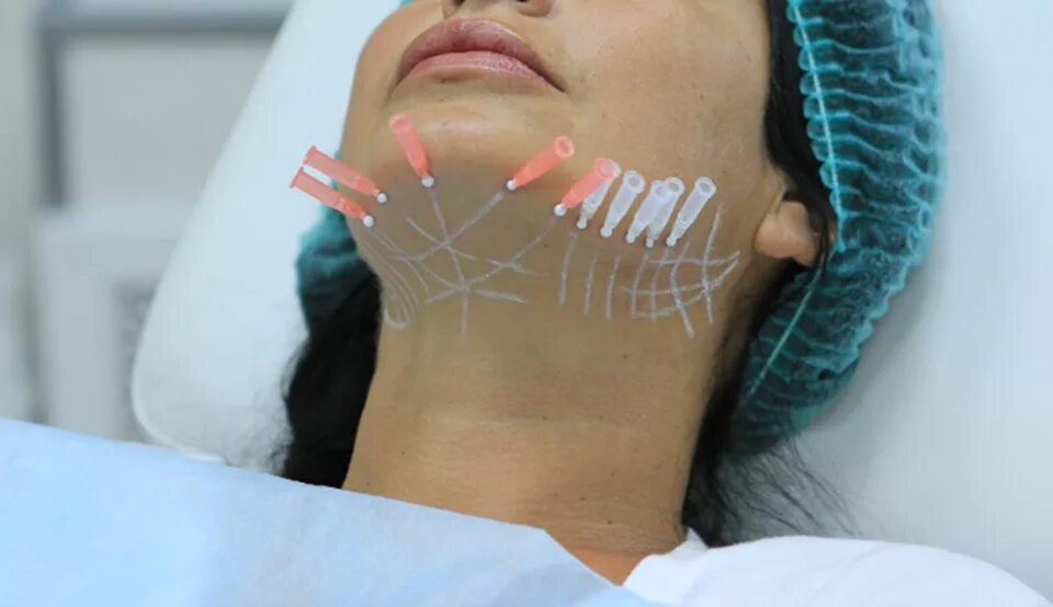 Тредлифтинг 3д мезонитями. Фотография нитями. Паук из ниток. Стринг арт. Нитки для пошива.