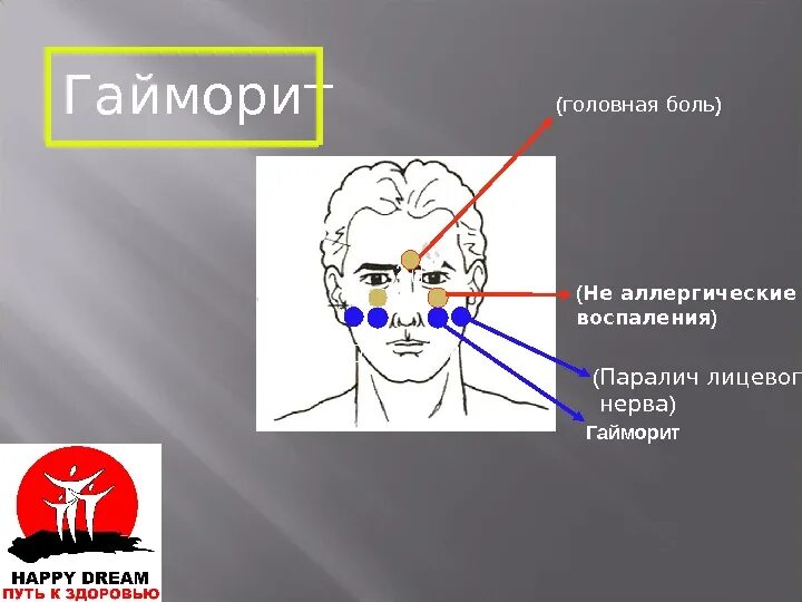 Гайморит головная боль. Воспаление тройничного нерва при гайморите. Головная боольпригайморите.