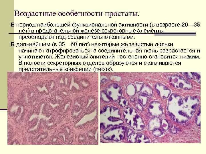 Простата детей. Строение предстательной железы гистология. Доброкачественная гиперплазия предстательной железы гистология. Эпителий предстательной железы гистология. Предстательная железа гистология препарат.