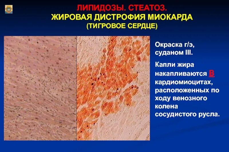 Липидоз печени
