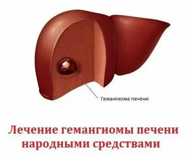 Гемангиома печени народные средства
