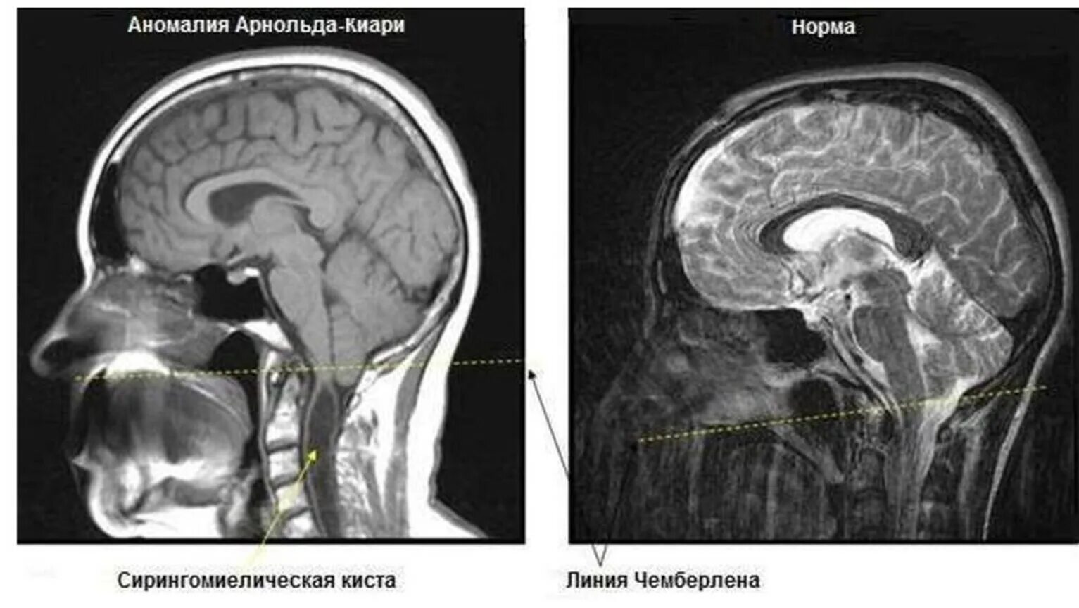 Аномалия Арнольда Киари мрт. Аномалия Арнольда Киари 1 мрт. Мальформация Арнольда-Киари 2 типа. Мальформация Арнольда-Киари мрт.