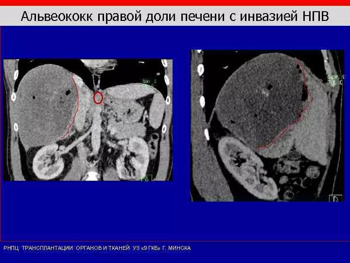 Образование в правой доле печени. Альвеококк заболевание печени.