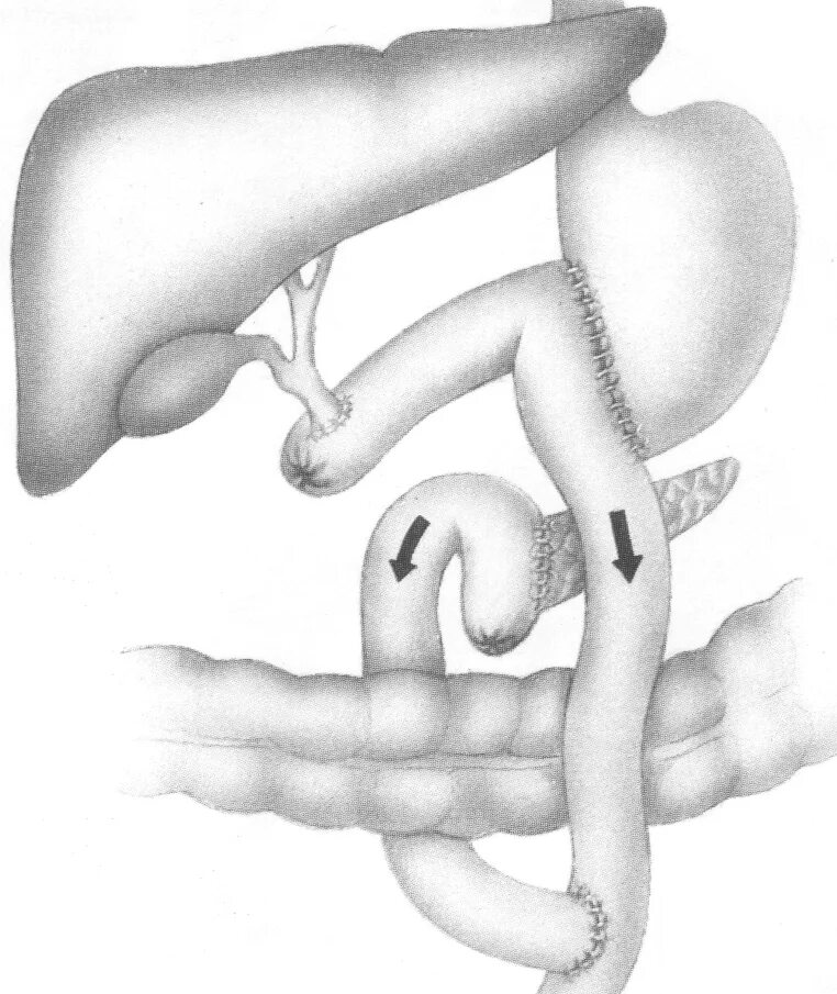 Панкреатодуоденальная резекция анастомозы. Резекция поджелудочной железы схема. Резекция головки поджелудочной железы. Резекция головки поджелудочной железы анастомозы.