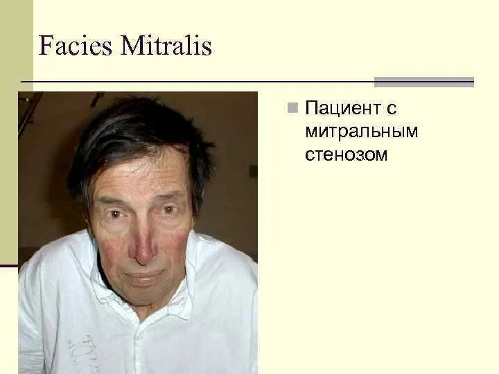 Больной с митральным стенозом. Больной с митральным стенозом. Внешний вид больного с митральным стенозом. Лицо больного митральным стенозом. Больной с митральным стенозом.