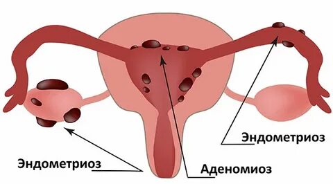 Эндометриоз после месячных