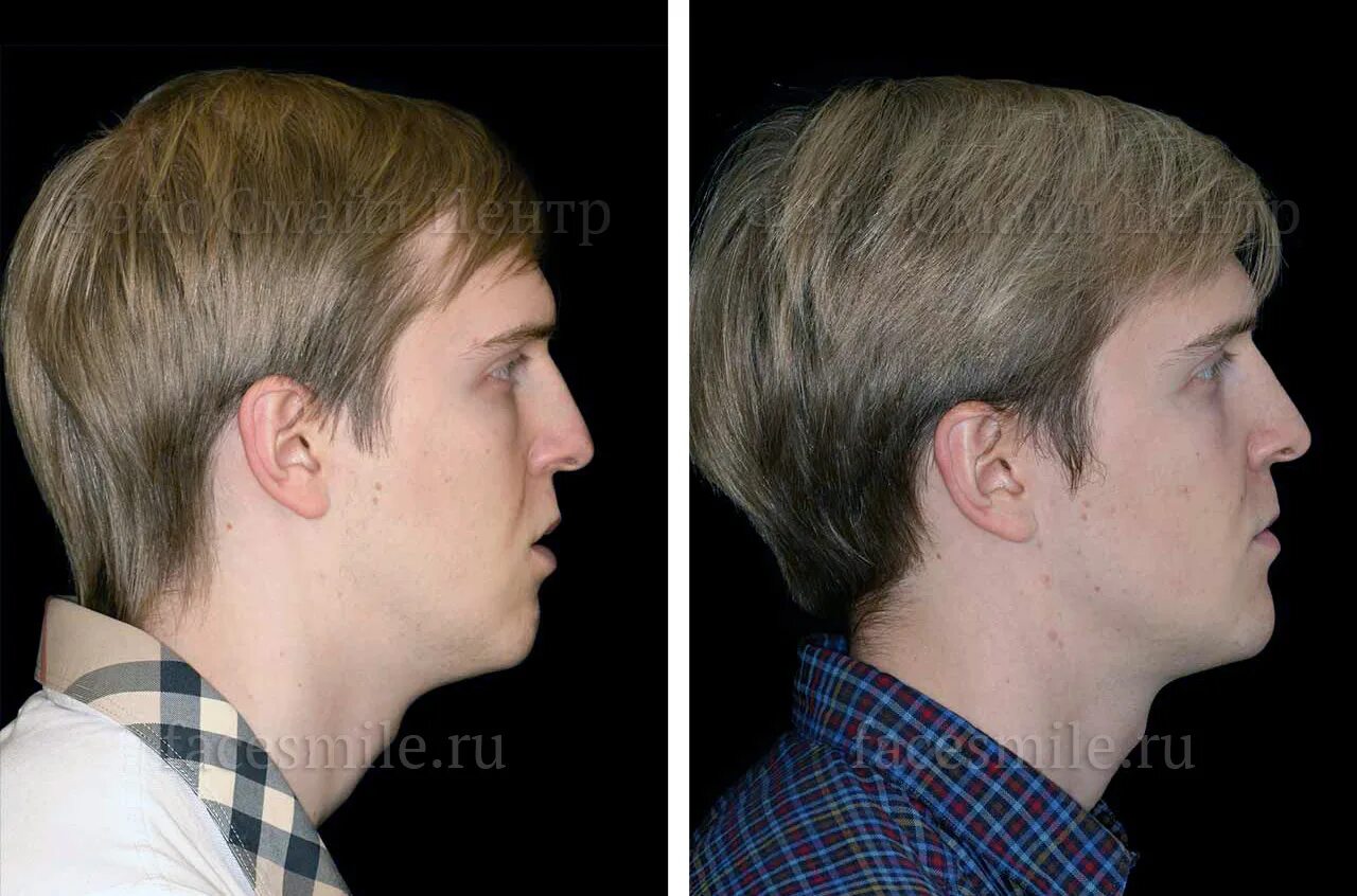Дистальный прикус до и после. Мезиальный прикус профиль. Мезиальный прикус до и после. Остеотомия челюсти до и после. Мезиальный прикус до после в профиль.