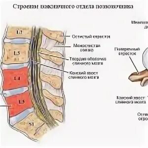 Дорзальная грыжа l5 s1