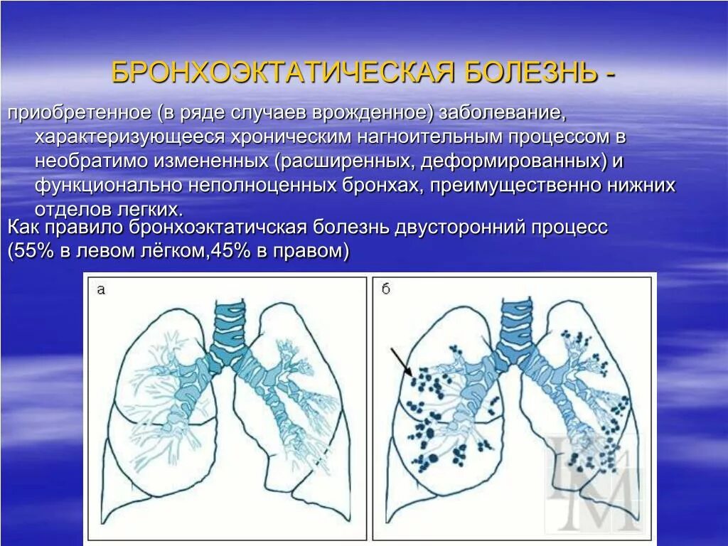 Бронхиальная болезнь легких. Бронхоэктазы рентгенологические синдромы. Врожденная бронхоэктатическая болезнь. Легочная ткань бронхоэктатическая болезнь. Бронхоэктатическая болезнь:бронхоэктатическая болезнь.