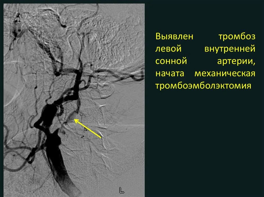 Стеноз устья вса. Неполная трифуркация левой внутренней сонной артерии. Тромбоз внутренней сонной артерии кт. УЗИ тромбоз внутренней сонной артерии.