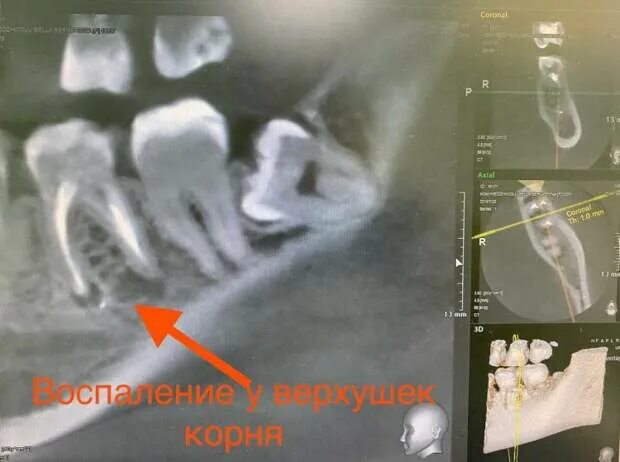 Есть вопрос: почему болит зуб, если нерв удалён? - ПолонСил.ру - социальная сеть