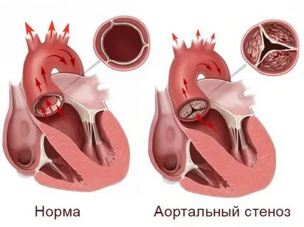 Порок аортального клапана двустворчатый