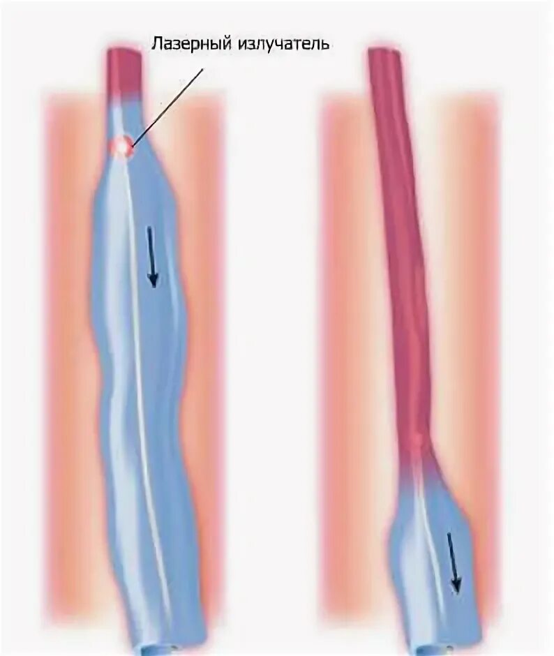 Лазерная коагуляция варикоз. Эндовенозная лазерная облитерация вен. Эндовенозная лазерная коагуляция варикозных вен. Эндовазальная лазерная абляция вен. Лазерная коагуляция после операции