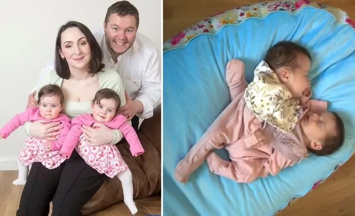 Как выглядят сиамские близнецы после разделения To Addy and Lily': A mother's letter to her conjoined twins, before surgery