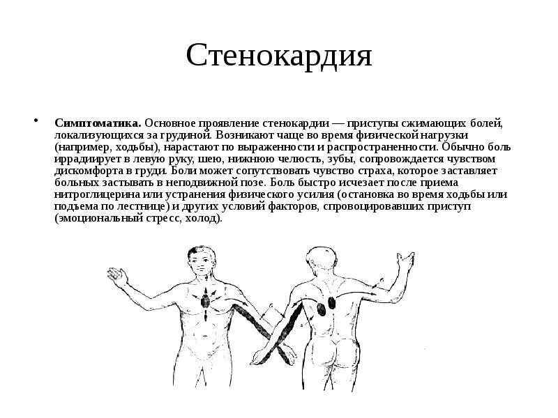 Что такое приступ стенокардии симптомы. Приступ стенокардии. стенокардия боль за грудиной. стенокардия иррадиация болей. боль за грудиной при стенокардии.