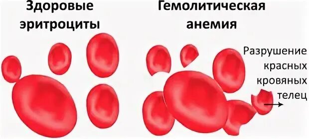 Распад эритроцитов. Аутоиммунная гемолитическая анемия картина крови. Гемолитические анемии рисунок эритроцитов. Гемолитическая анемия эритроциты форма. Эритроциты при гемолитической анемии.