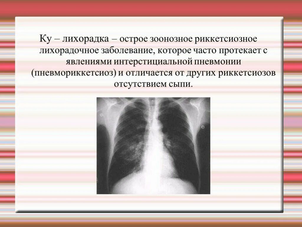 Ку лихорадка эпидемиология. Ку лихорадка клиническая картина. Специфическая профилактика ку лихорадки.