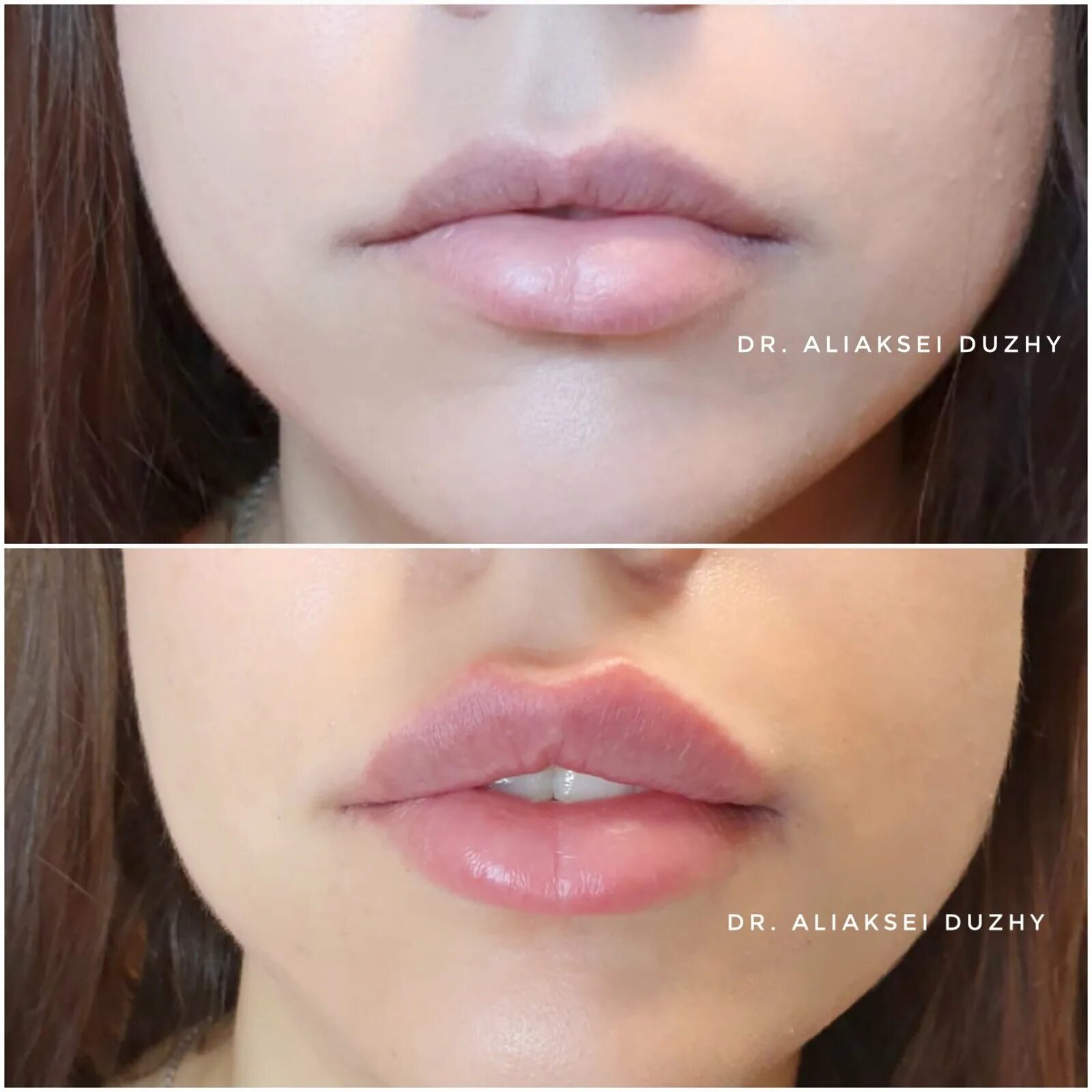 Форма губ бант. Форма губ бантиком. форма губ для увеличения. популярная форма губ.