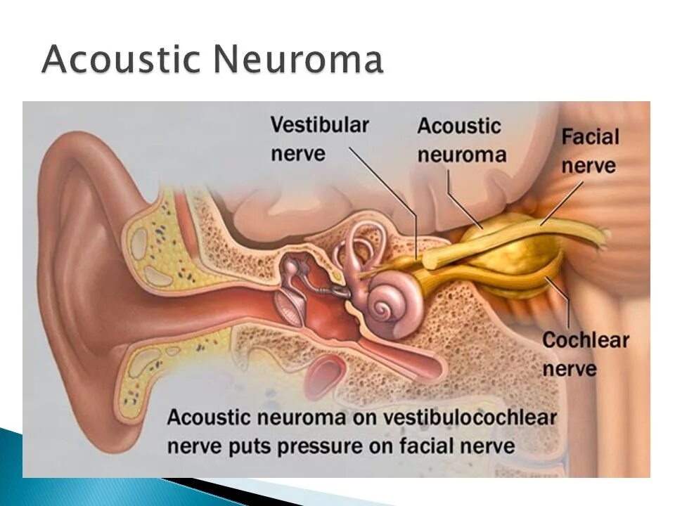 Поражение слухового нерва. Функции слухового нерва. Слуховой нерв строение невринома. Невринома вестибулярного нерва.