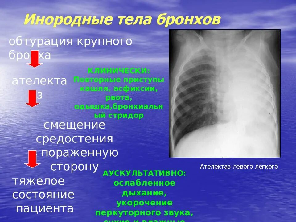 Инородные Тела Трахеи Бронхов