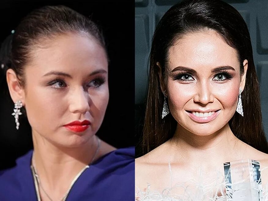 Ляйсан Утяшева до и после пластики - 300 экспертов.РУ