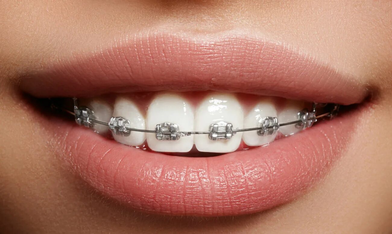 Brackets photo. Brackets photo