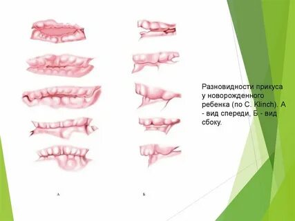 Прикусы виды логопедия