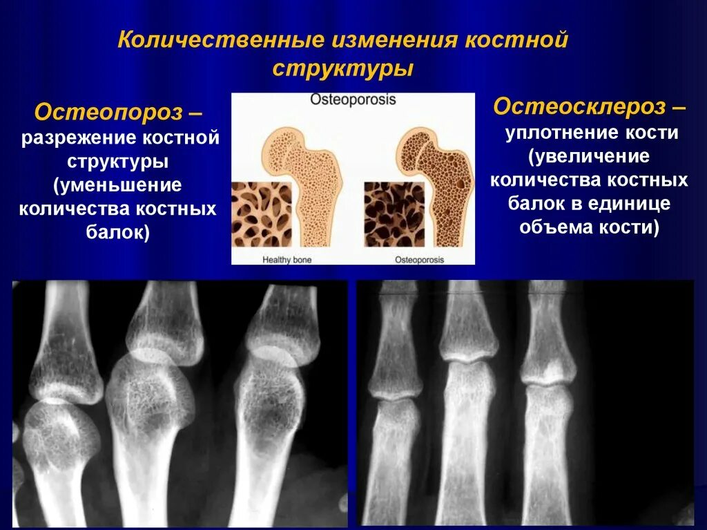 Изменения костной структуры