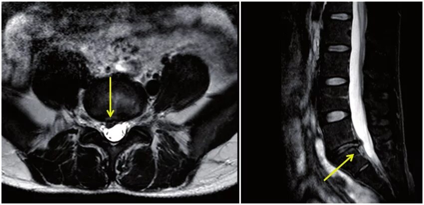 Параартикулярная киста. Микрохирургическая фенестрация флавэктомия l5-s1 слева. Sacralization of l5 MRI. Киста лимфатического протока поясница мрт. Киста в пояснице