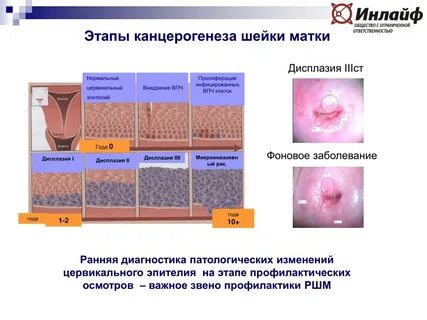 Неоплазия высокой степени шейки матки