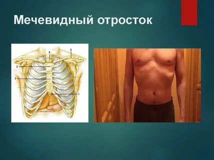 Воспаление мечевидного отростка грудины