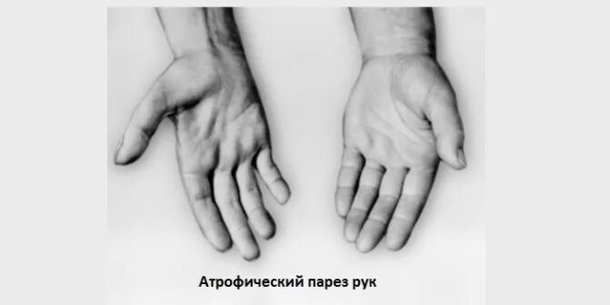 Парез 2 5. Сирингомиелия парез.